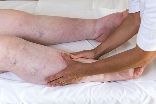 Terapista che esegue il massaggio linfodrenante  manuale su gambe con problemi di edema linfatico