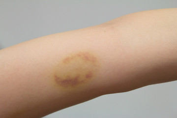Bruise on wound female arm