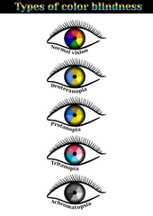 Types of color blindness. Violation of color perception: deuteranopia, protanopia, tritanopia, achromatopsia.   