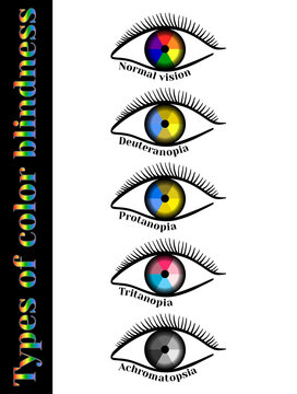 Types of color blindness. Violation of color perception: deuteranopia, protanopia, tritanopia, achromatopsia.   