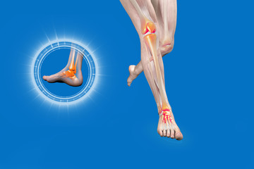 medital tibial stress syndrome