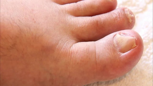Macro View of Left Leg of Elderly Man With Nail Fungus on the Toes