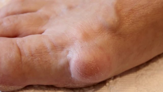 Female Leg With Hallux Valgus