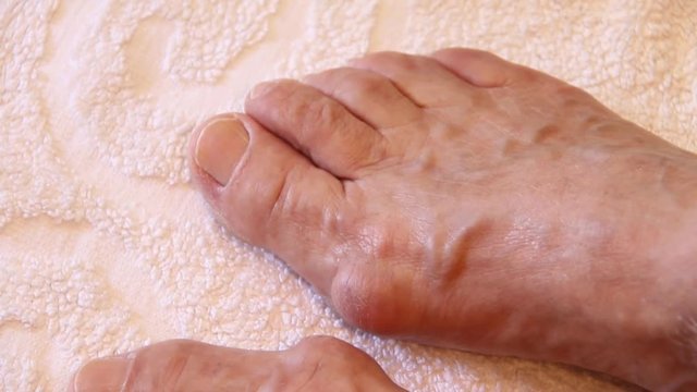 Hallux Valgus of Elderly Woman Legs