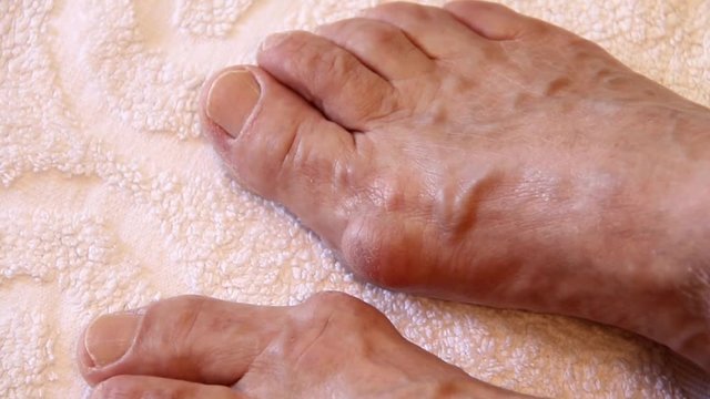 Elderly Famale Legs With Valgus Deformity