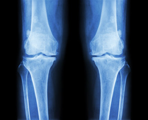 Osteoarthritis both knee .  film x-ray AP ( anterior - posterior ) of knee show narrow joint space , osteophyte ( spur ) , subcondral sclerosis
