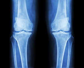 Osteoarthritis both knee .  film x-ray AP ( anterior - posterior ) of knee show narrow joint space...