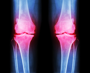 Osteoarthritis both knee .  film x-ray AP ( anterior - posterior ) of knee show narrow joint space , osteophyte ( spur ) , subcondral sclerosis