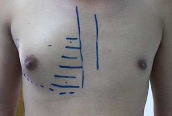 male patient with chest wall mass
