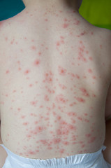 Chicken pox