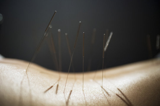 Close up of acupuncture needles on back against black background