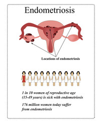 Endometriosis. Endometrial cysts. The endometrium. Statistics endometriosis. The structure of the pelvic organs. Infographics. Vector illustration on isolated background