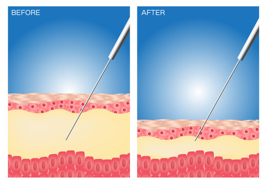 Акваликс отзывы до и после Rejuvenation Изображения: просматривайте стоковые фотографии, векторные изображе