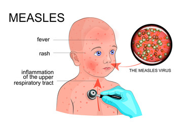 the boy with the symptoms of rubella or measles - obrazy, fototapety, plakaty