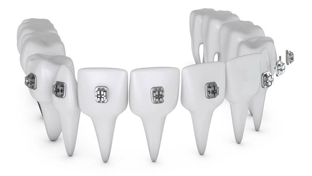 Animation dental brackets and tooth implant on a white background