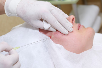 Procedure of face lifting surgery.