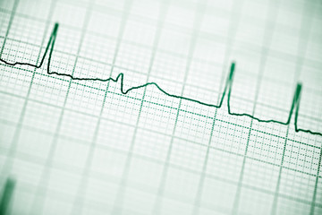 Electrocardiogram