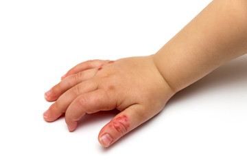 Kinderhand mit Hautkrankheit und wunden Stellen auf weißem Hintergrund isoliert