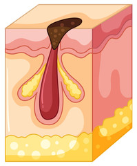 Diagram of blackhead pimple