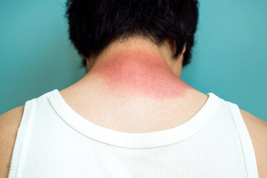 日焼け, 男性