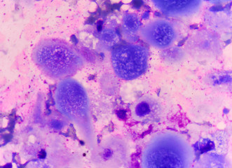 Cell in human showing abnormal cells.