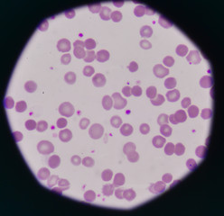 abnormal red blood cells