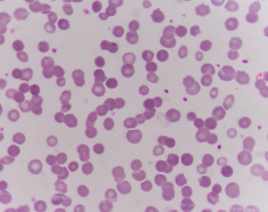 abnormal red blood cells