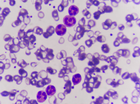 Neutrophil Cell (white Blood Cell) In Peripheral Blood Smear, Wr