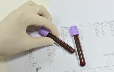  Blood test for Complete Blood Count. CBC