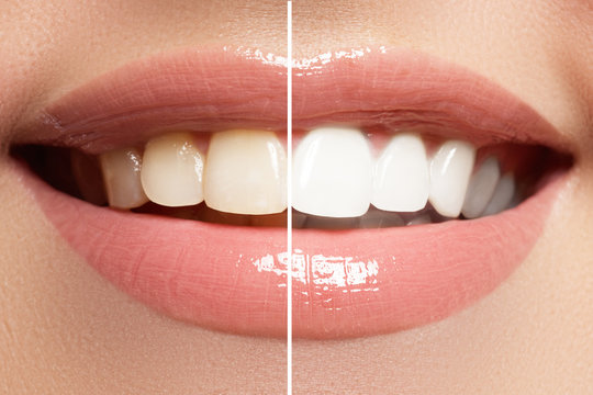 Perfect smile before and after bleaching. Dental care and whitening teeth
