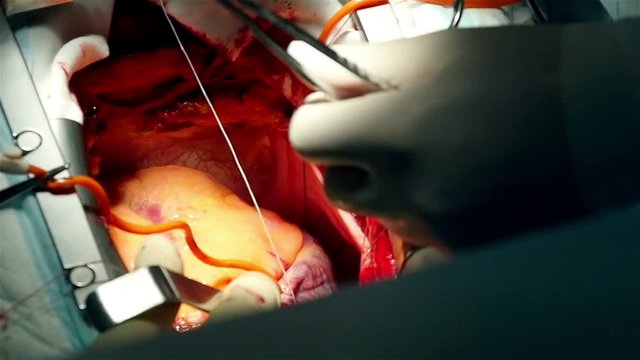 surgical operation on the human heart, close-up, slow motion