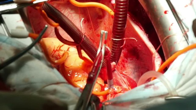 surgery on the human heart, close-up