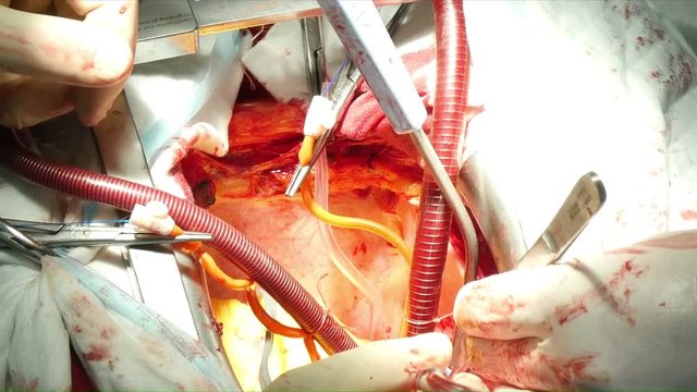 human abdominal cavity during surgery, close-up