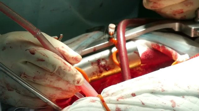 pumping blood from the peritoneal cavity during surgery