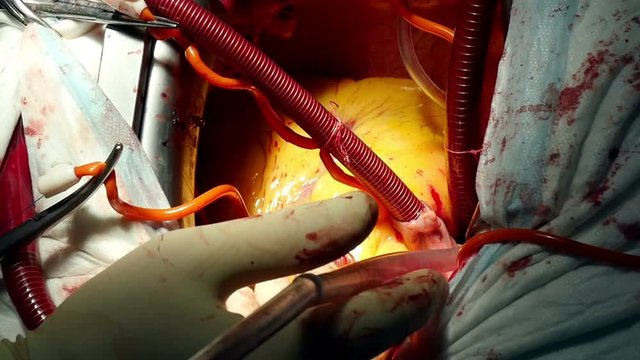 surgery on the human heart in the operating room, close-up