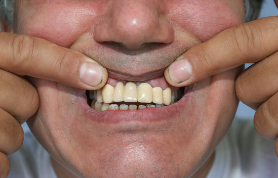 man showing false front upper teeth