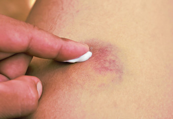 Cropped image of a young woman putting moisturizer onto her finger on a great hematoma