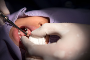 Caries tooth extraction by the dentist. Dentistry in hospital  