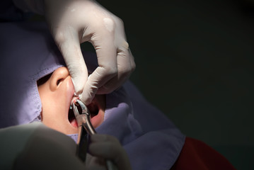 Caries tooth extraction by the dentist. Dentistry in hospital  