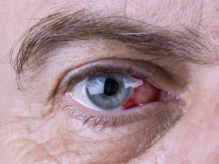 Fototapeta premium Close-up of an eye, which has suffered a blood spill