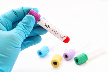 Blood sample positive with Mycobacterium tuberculosis (MTB) positive
