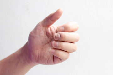 Fungus Infection on Nails Hand, Finger with onychomycosis. - soft focus