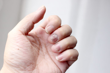 Fungus Infection on Nails Hand, Finger with onychomycosis. - soft focus