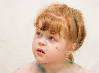 Маленькая девочка, больная ветряной оспой