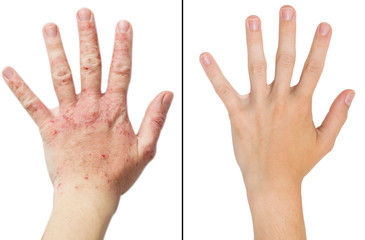 Real photo girl's hand, the patient with eczema before and after treatment - obrazy, fototapety, plakaty