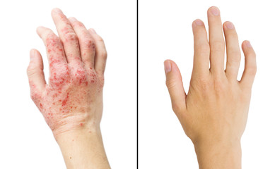 Real photo girl's hand, the patient with eczema before and after treatment