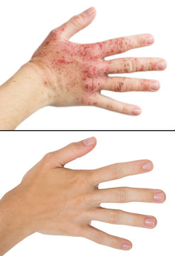 Real photo girl's hand, the patient with eczema before and after treatment