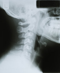 Human Neck Xray