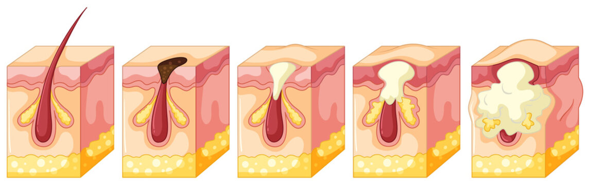 Diagram of pimple on human skin