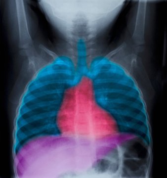 Normal chest X-ray of a 2 year old girl